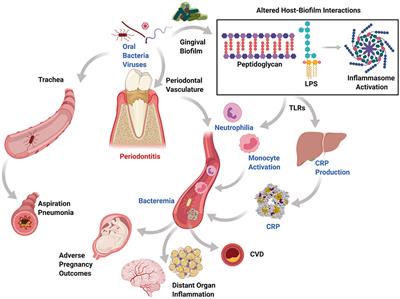 The Relationships Among Periodontitis, Pneumonia and COVID-19